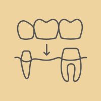 Dental Bridges